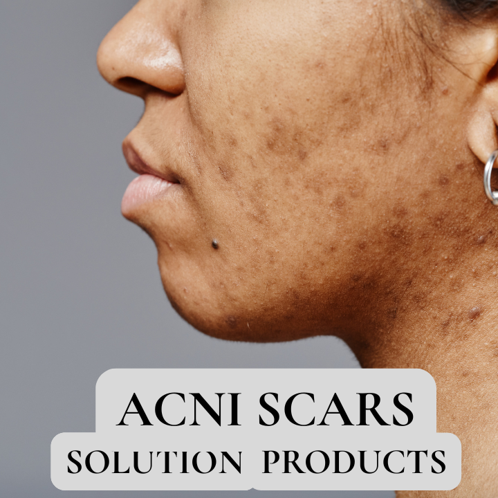 Ance Scars Removal Products